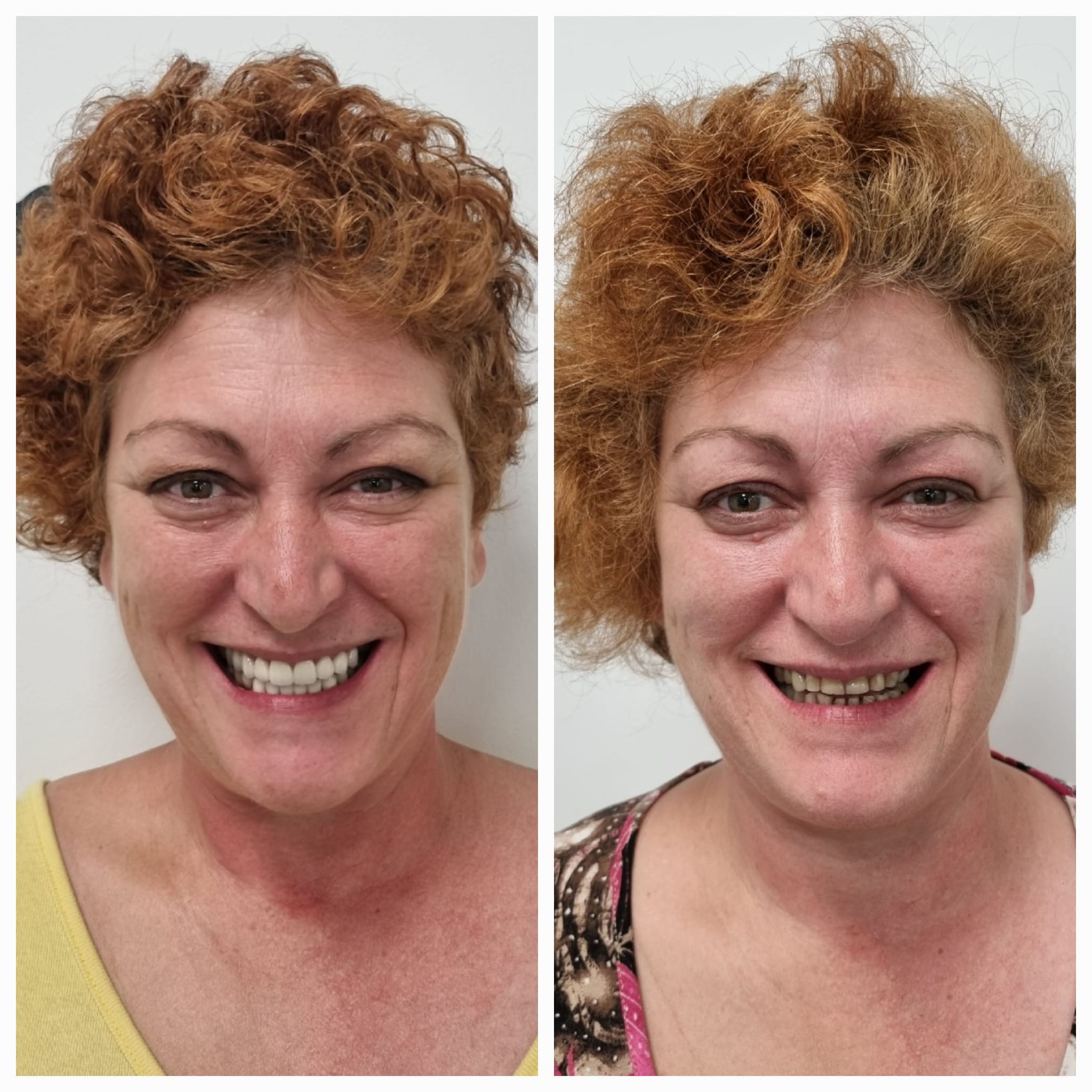 Antes y después de tratamiento dental con resultado natural en la sonrisa