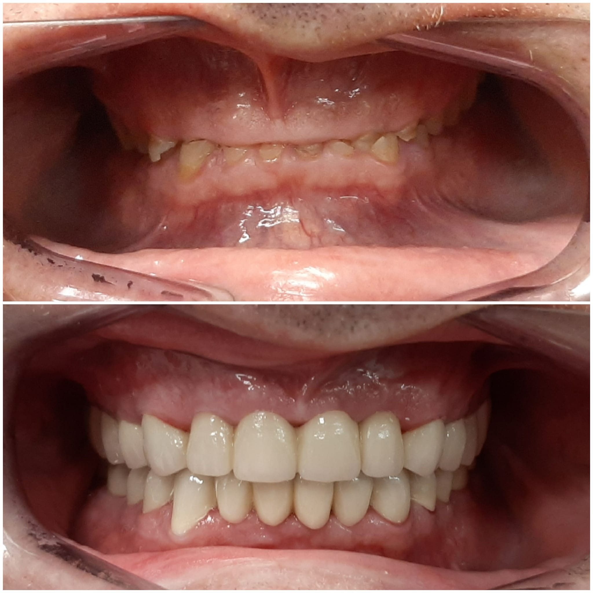 Resultado antes y después con recuperación estética de la sonrisa