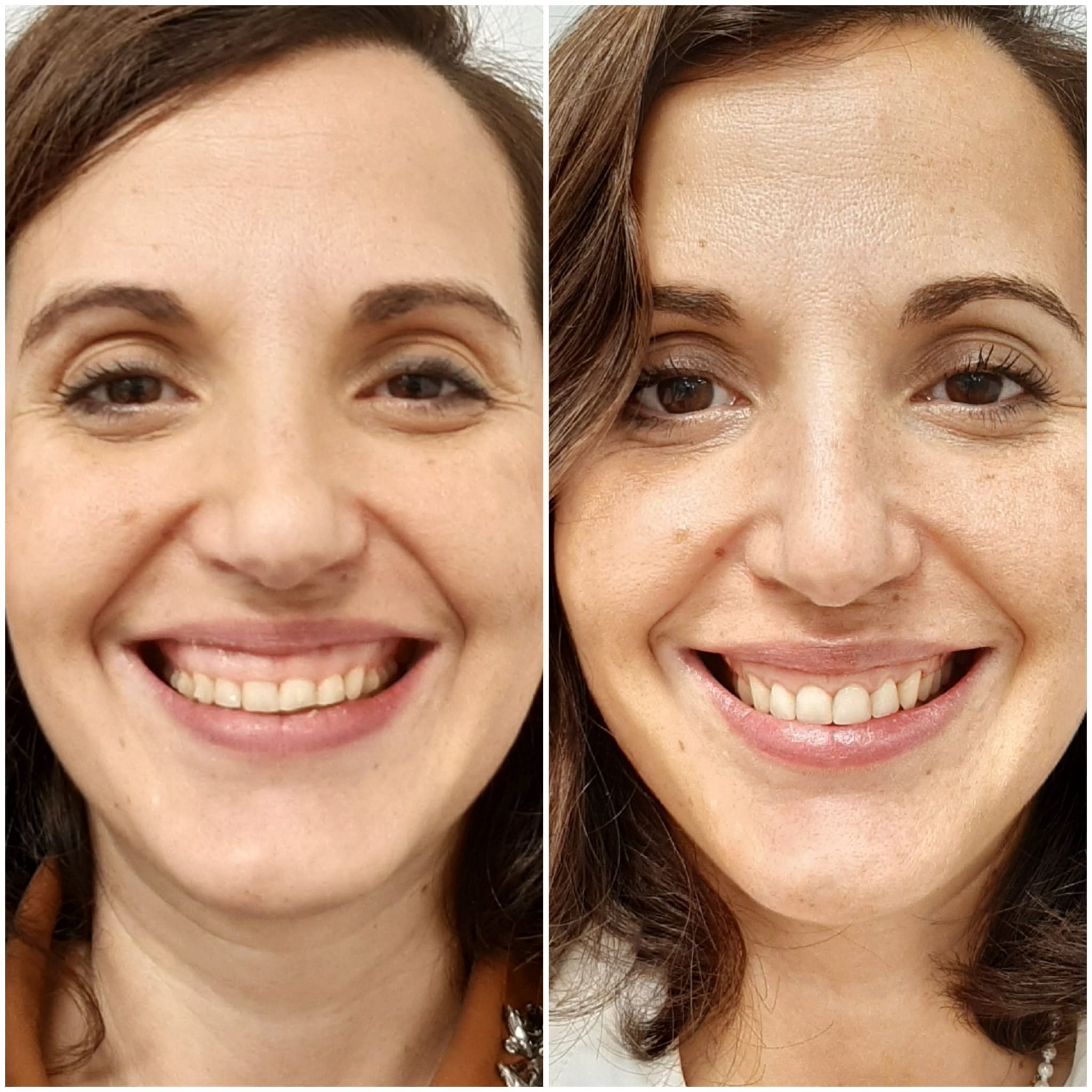 Resultado antes y después con mejora de la sonrisa y estética dental