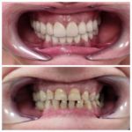 Antes y después de tratamiento dental con mejora visible de los dientes