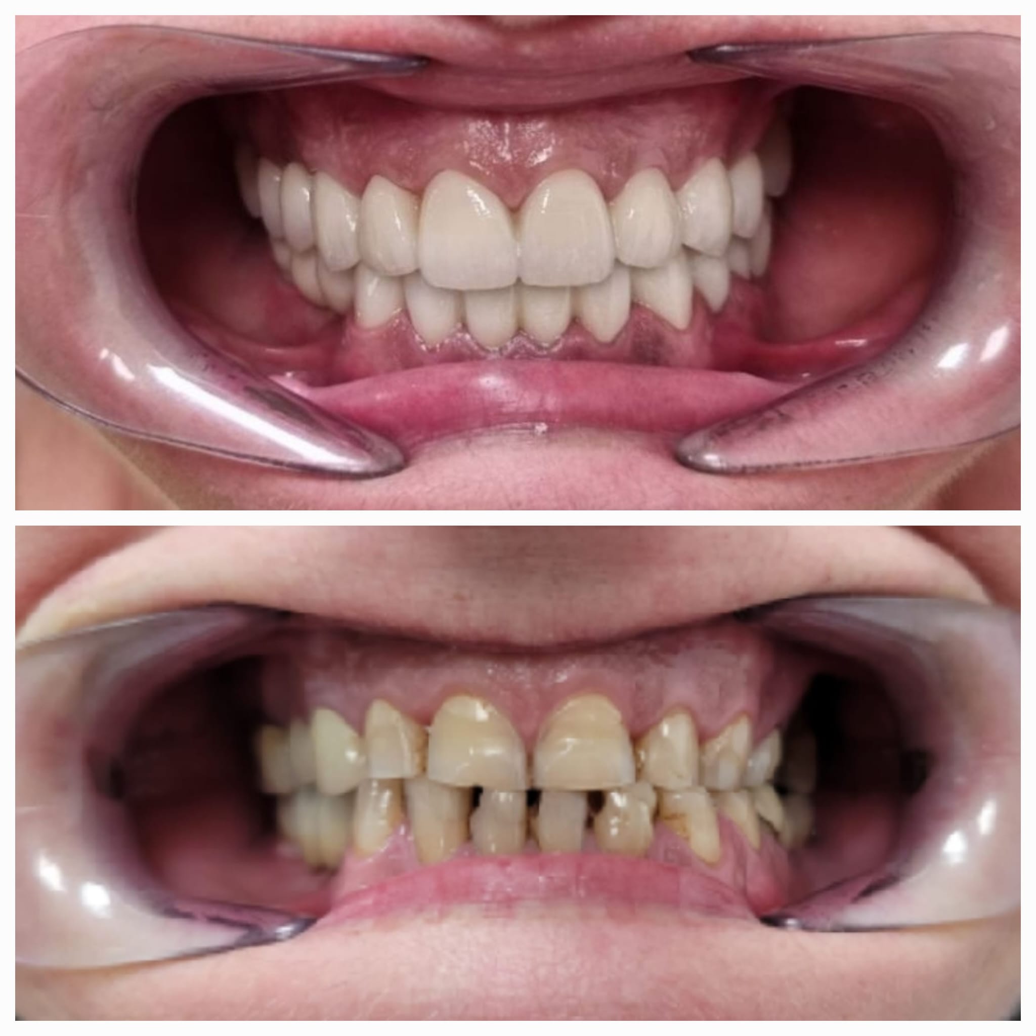 Antes y después de tratamiento dental con mejora visible de los dientes