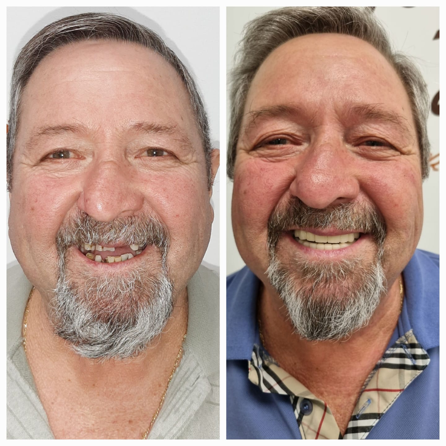 Antes y después de tratamiento dental con mejora estética dental