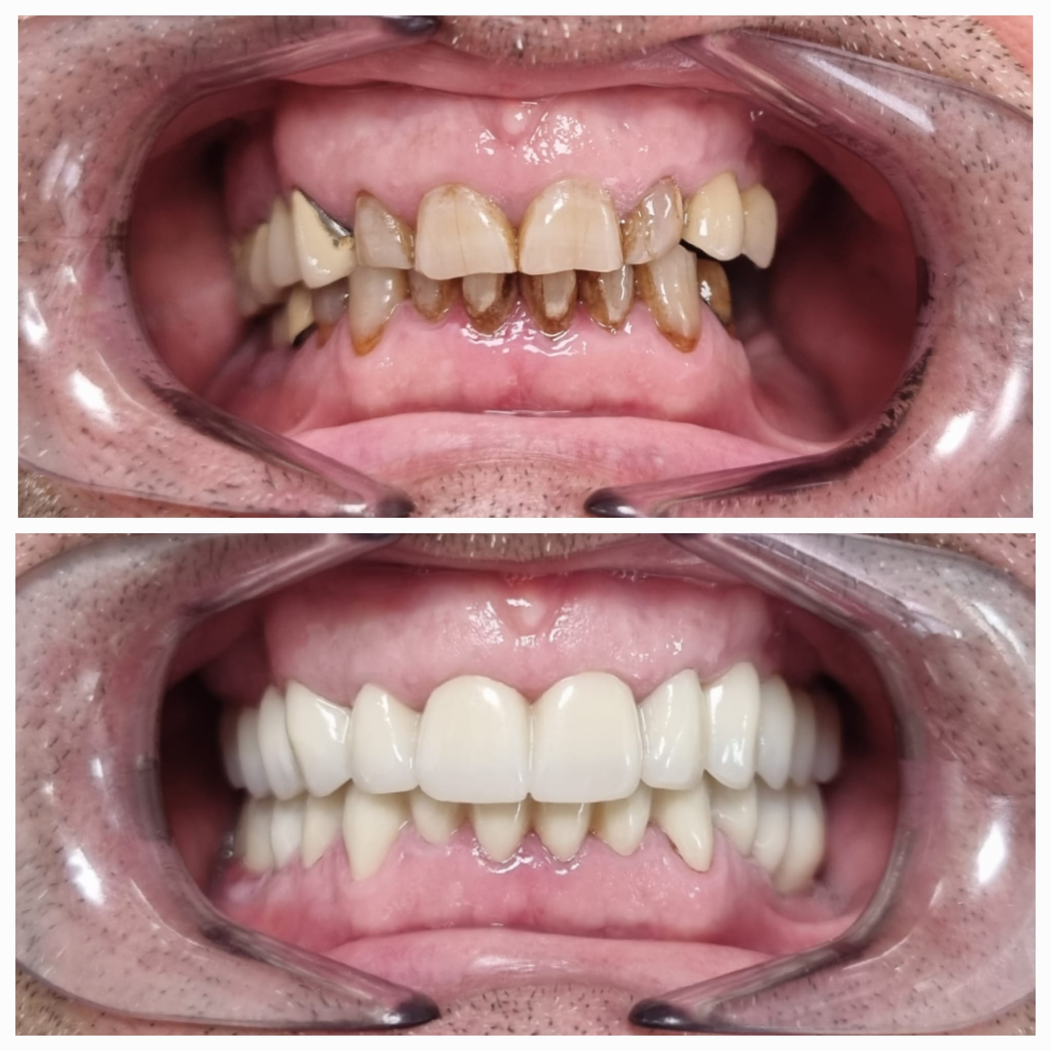 Antes y después de tratamiento dental con mejora de la alineación y estética