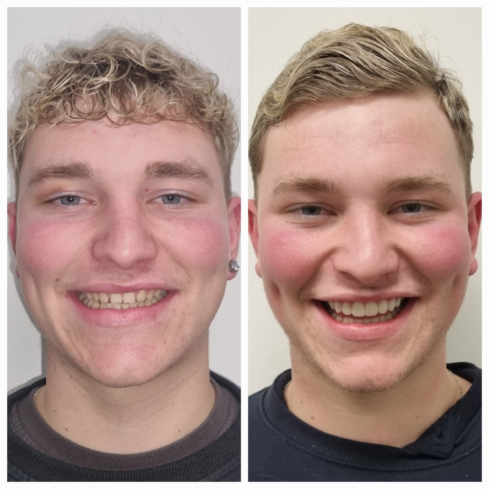 Resultado antes y después con sonrisa más uniforme y estética