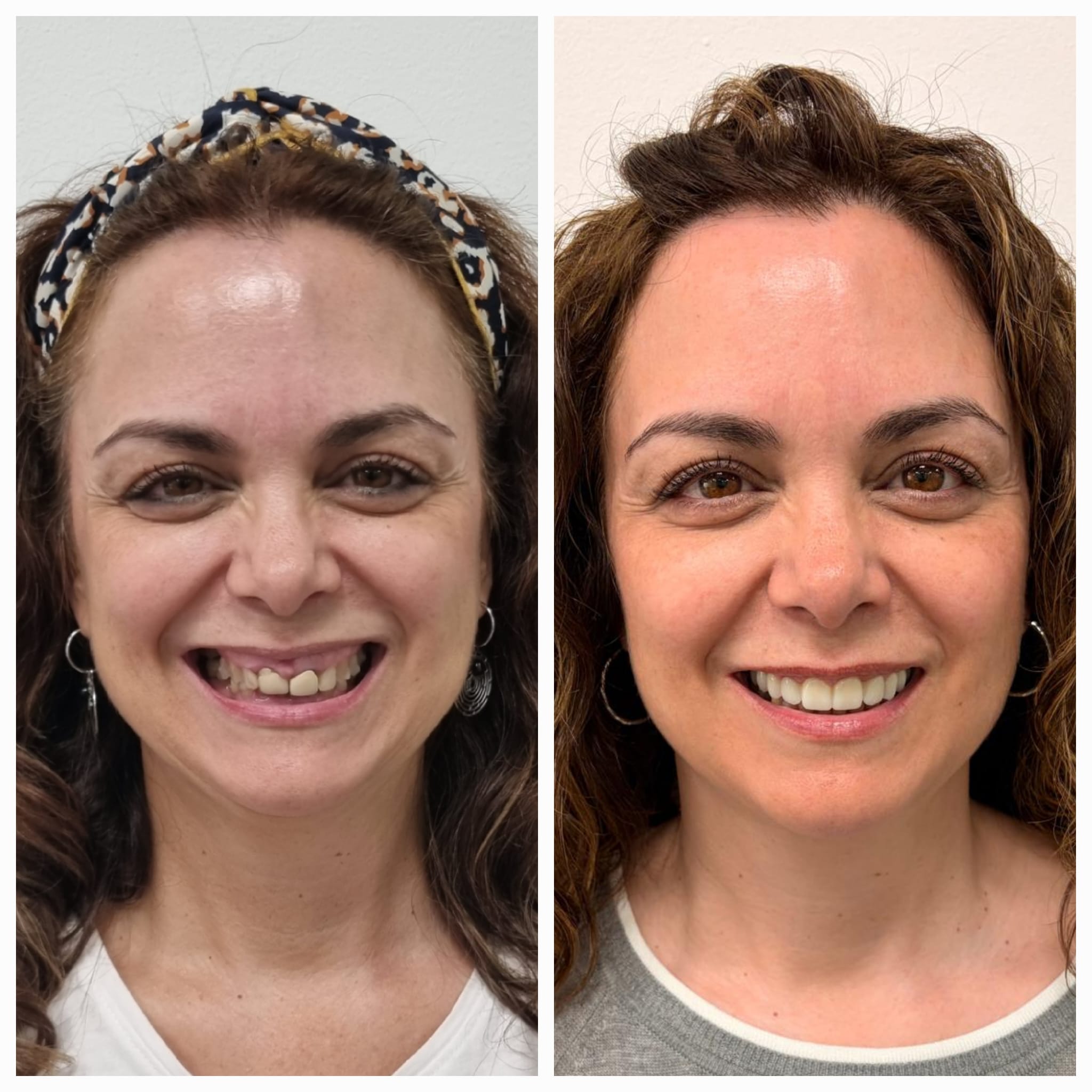 Antes y después de tratamiento dental con mejora estética de la sonrisa