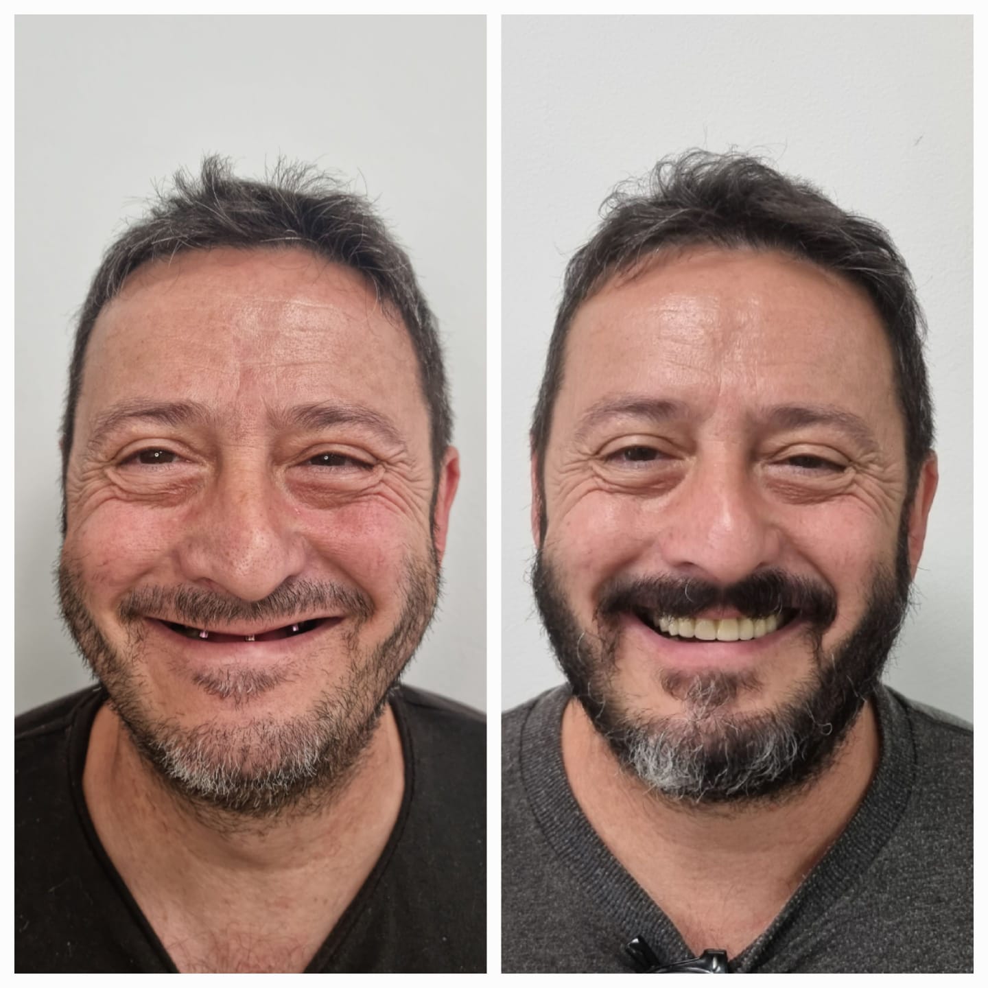 Antes y después de tratamiento dental con mejora visible de la sonrisa