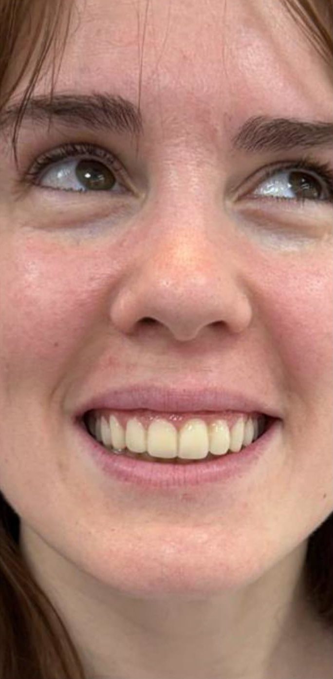 Después del tratamiento dental con resultado natural y estético