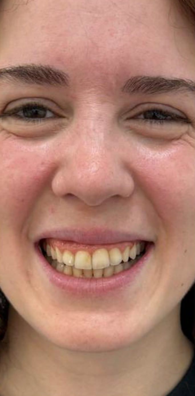 Antes del tratamiento dental con dientes en estado previo