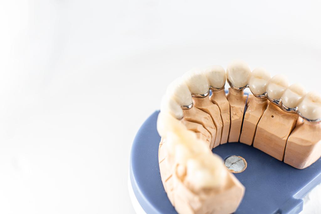Modelo dental utilizado para la planificación de implantes dentales y rehabilitación oral en Castellón.
