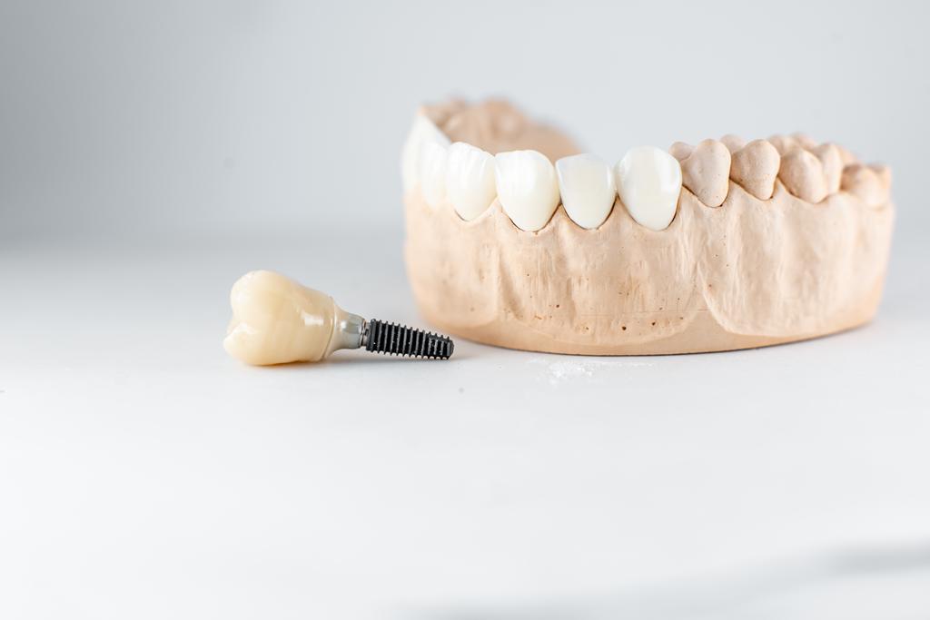 Implante dental con corona para la rehabilitación de dientes perdidos mediante implantología avanzada en Castellón.