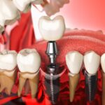 Implante dental con corona para la rehabilitación de dientes perdidos mediante implantología avanzada en Castellón.