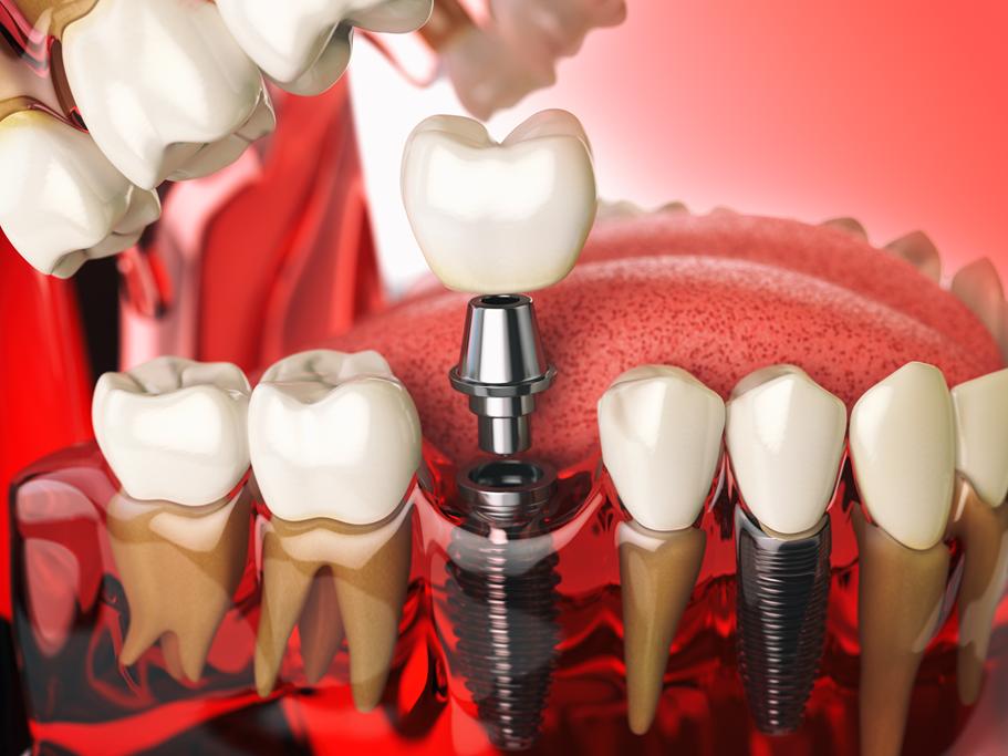 Implantes dentales y regeneración ósea: tratamientos combinados
