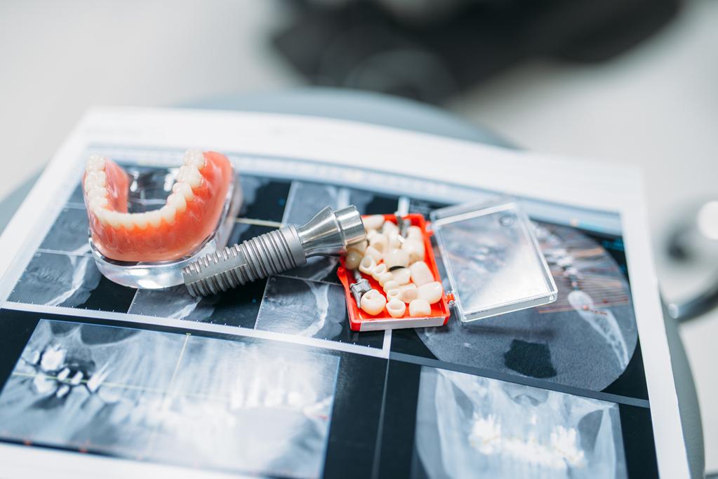 Implante dental y estudio radiológico utilizados para la planificación personalizada de tratamientos de implantología en Castellón.