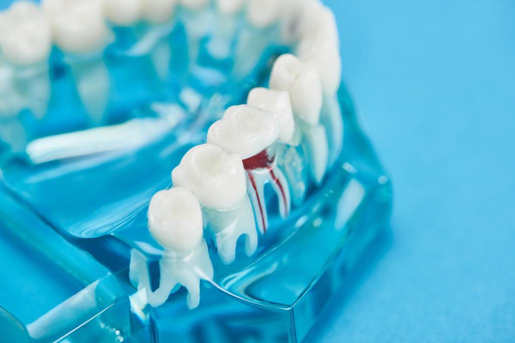 Tratamiento de elevación de seno maxilar para aumentar el volumen óseo y facilitar la colocación de implantes dentales en Castellón.