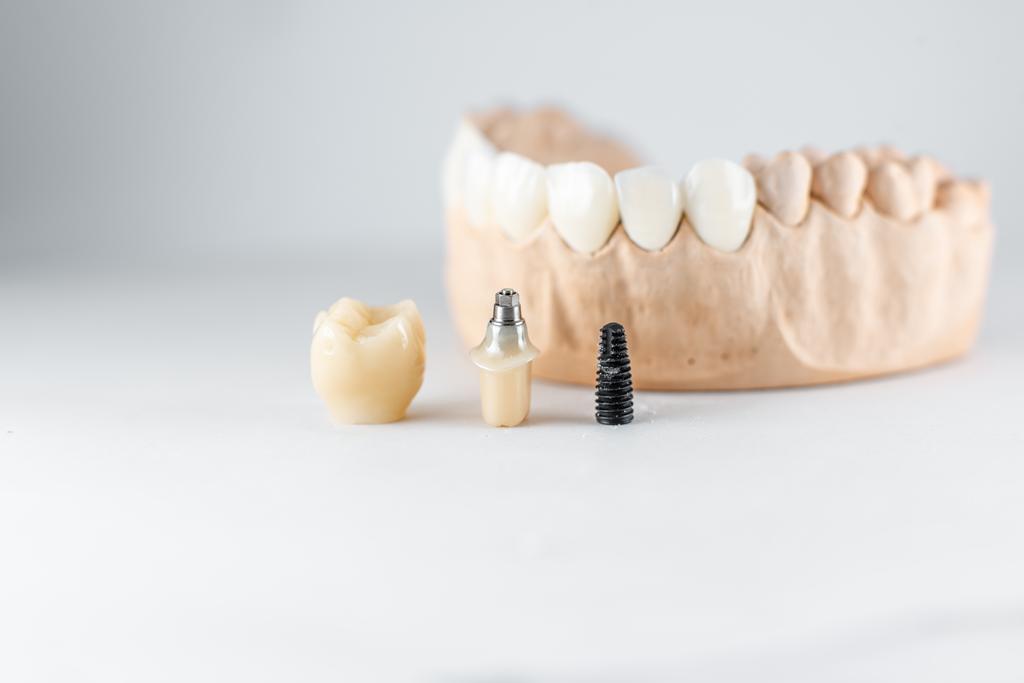 Implante dental, corona y pilares protésicos para tratamientos de implantología y rehabilitación oral en Castellón.