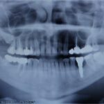 Radiografía panorámica utilizada para la planificación de tratamientos de implantes dentales y cirugía oral en Castellón.