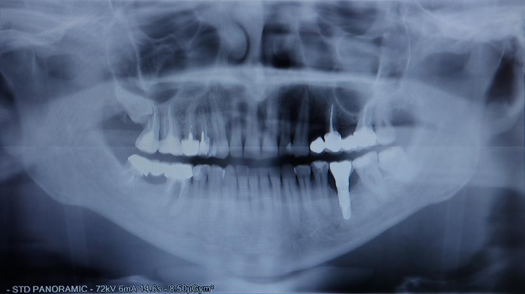 Cuánto tiempo tarda un tratamiento de implantes dentales