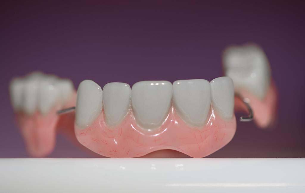 Prótesis dental parcial removible utilizada para sustituir varias piezas dentales y recuperar la función masticatoria.