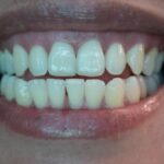 Sonrisa saludable tras un tratamiento de implantología y rehabilitación oral en Castellón.