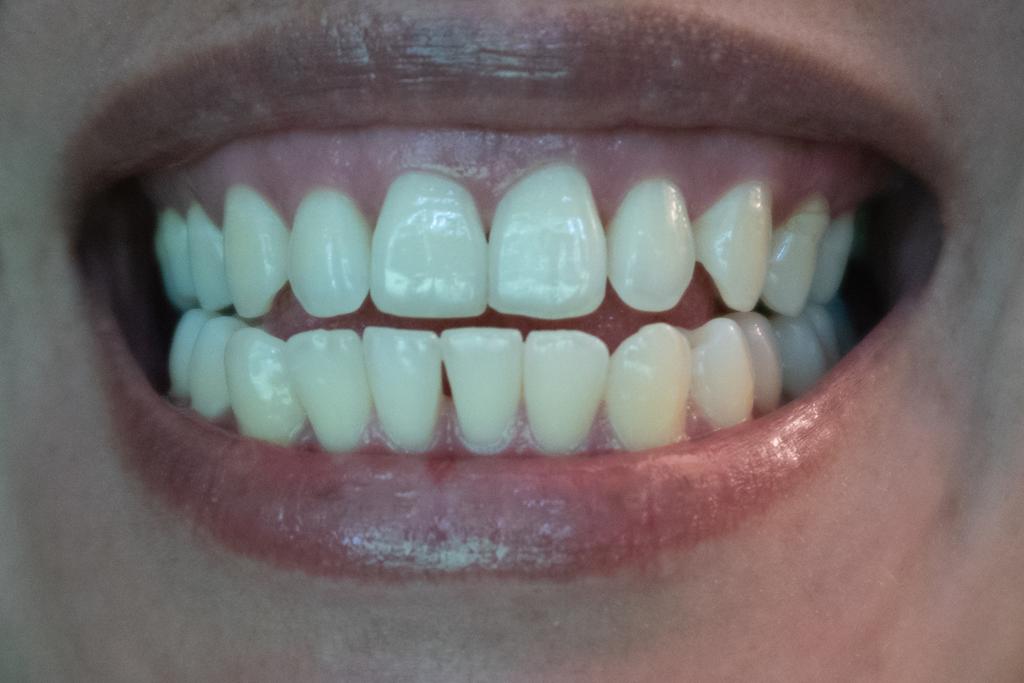 Beneficios de recuperar la sonrisa con implantes dentales
